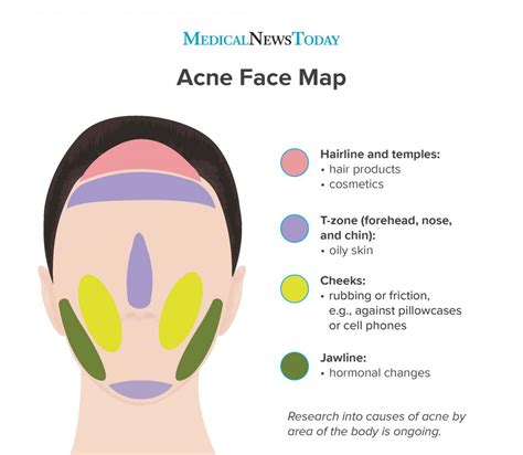 What Causes Acne Chart