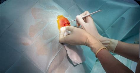 What Causes Cyst Under Breast
